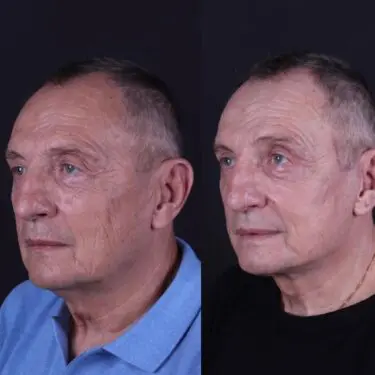 Facelift & neck lifting