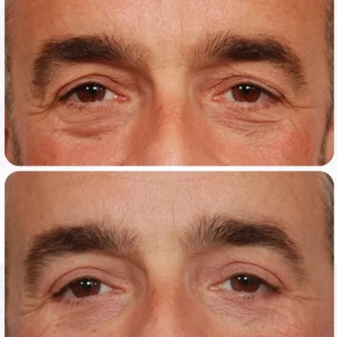 Блефаропластика