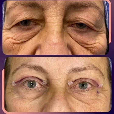 Блефаропластика