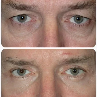 Блефаропластика