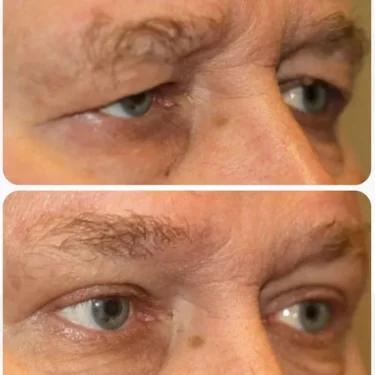 Блефаропластика