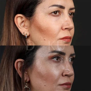 Блефаропластика