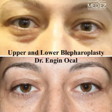 Блефаропластика