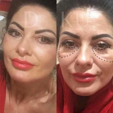 Блефаропластика