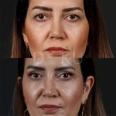 Блефаропластика