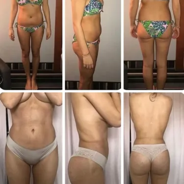 Liposuction