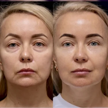 Блефаропластика