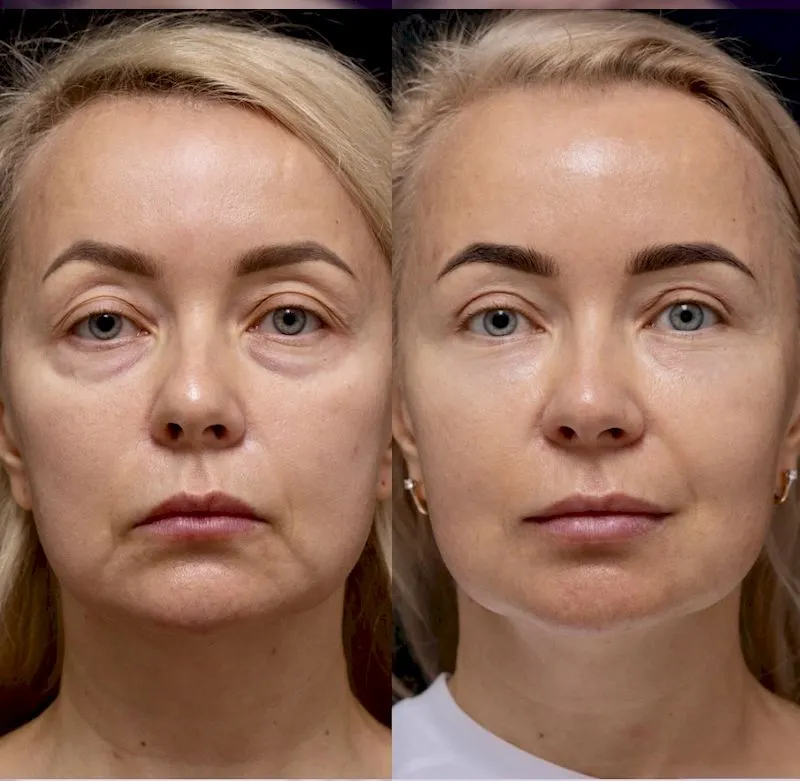 Blefaroplastia en Estambul