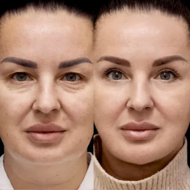 Блефаропластика