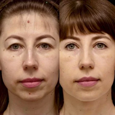 Блефаропластика