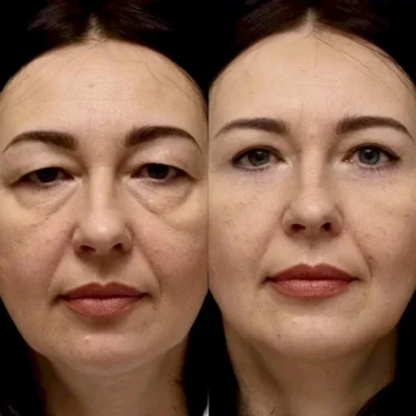 Блефаропластика