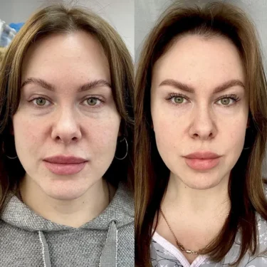 Блефаропластика