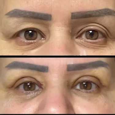 Блефаропластика