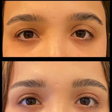 Блефаропластика