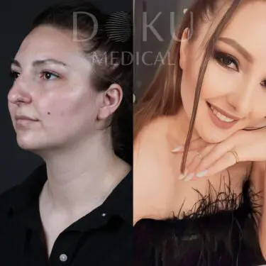 Facelift & neck lifting