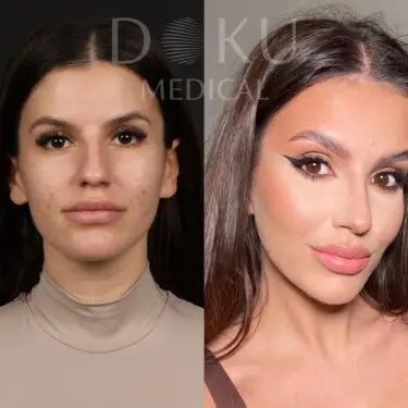 Facelift & neck lifting