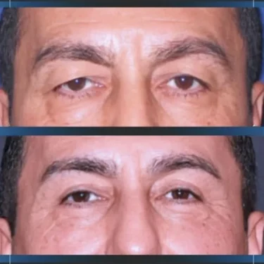 Блефаропластика