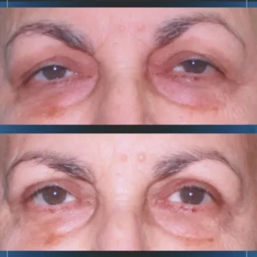 Блефаропластика