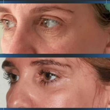 Блефаропластика