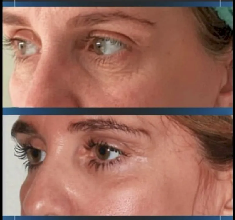 Blefaroplastia en Turquía – Beauty by Experts Medical