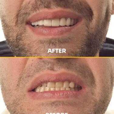 Blanchiment des dents