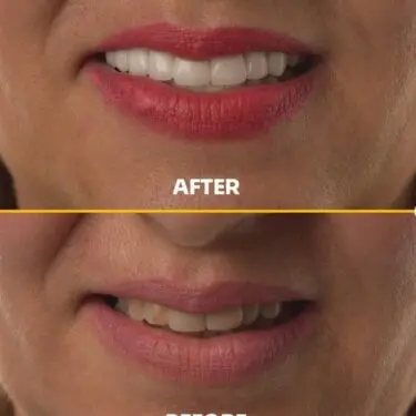 Blanchiment des dents