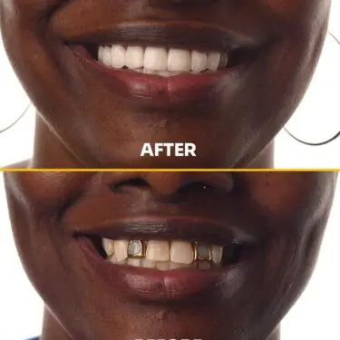 Blanchiment des dents