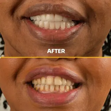 Blanchiment des dents