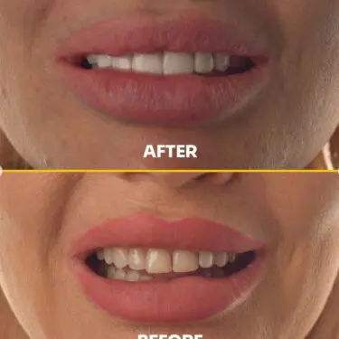 Blanchiment des dents