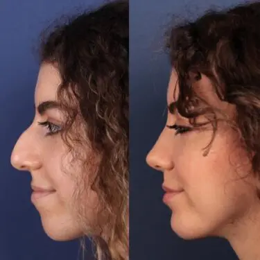 Revision rhinoplasty