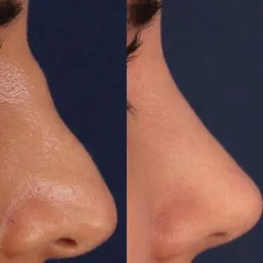 Rhinoplastik