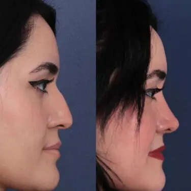 Ринопластика