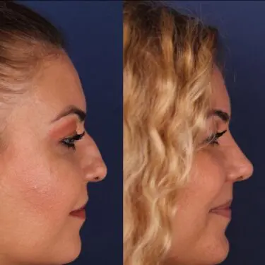 Ринопластика