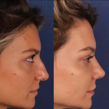 Ринопластика