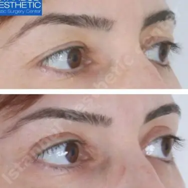 Blepharoplastik