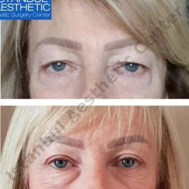 Blepharoplastik
