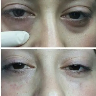 Blepharoplastik