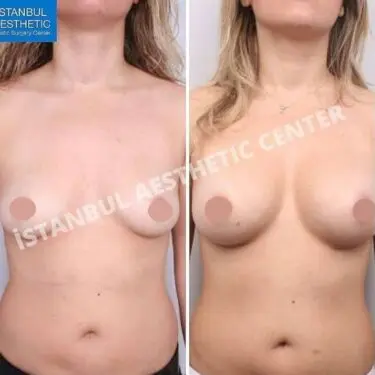 Mammoplastik