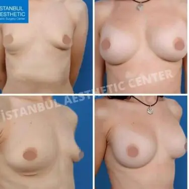 Mammoplastik