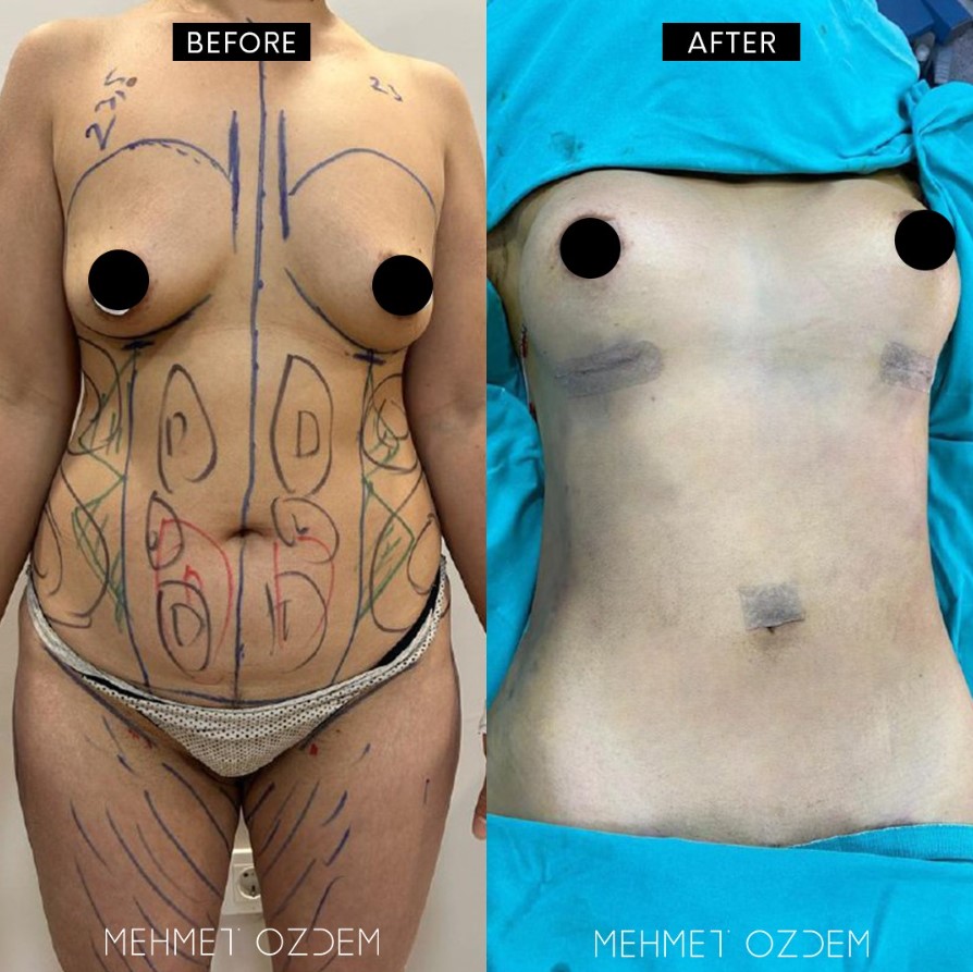 Liposuction + Tummy Tuck