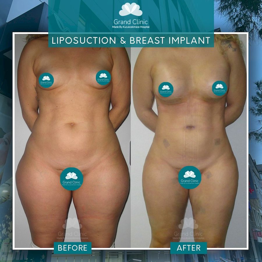 Liposucción, implantes mamarios