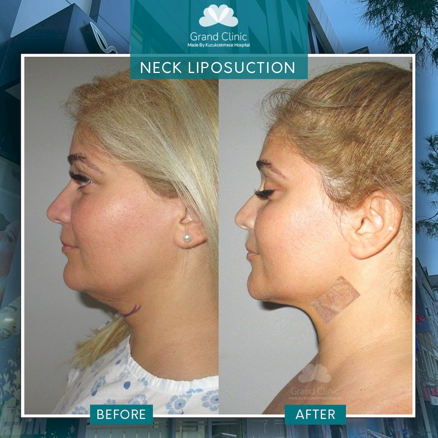 Liposuction of chin, neck