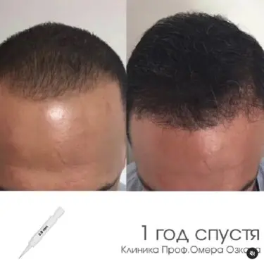 Haartransplantation