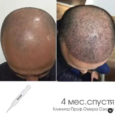 Haartransplantation
