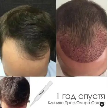 Haartransplantation