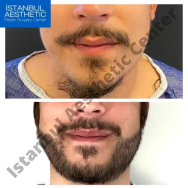 Trasplante de barba