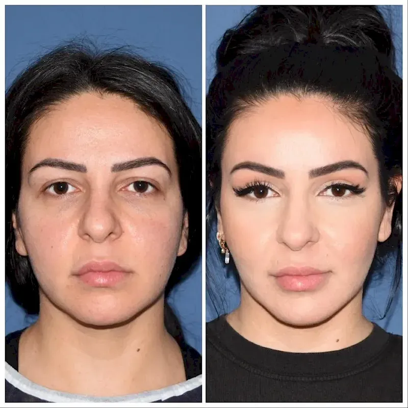Blefaroplastia en Turquía