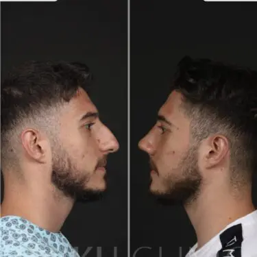 Ринопластика