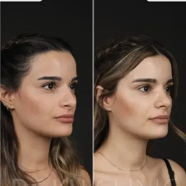 Ринопластика