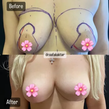 Breast lift